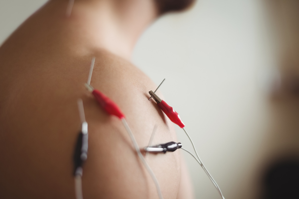 close up patient getting electro dry needling